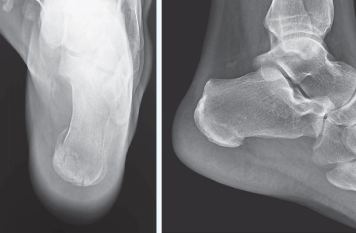 35-Year-Old With Heel Pain After a Fall X-ray Images