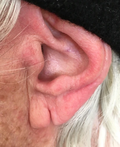 Traumatic tear of an ear lob due to earring (healed).