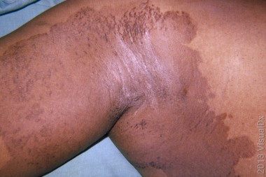 53-Year-Old With Spreading Rash