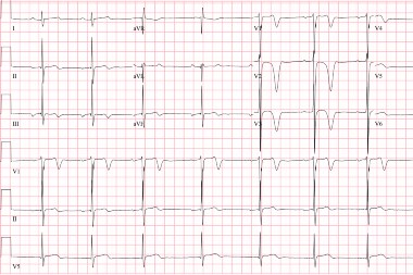 18-Year-Old With Chest Pain