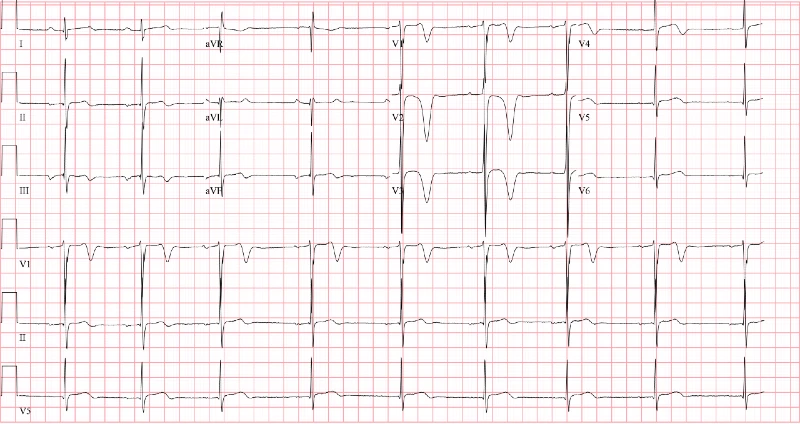 Initial ECG - hypertrophic cardiomyopathy