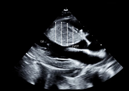 hypertrophic cardiomyopathy