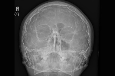 12-Year-Old With Facial Trauma