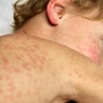 Measles Cases Reported in 8 States, New York Measles Emergency