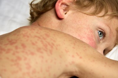 Measles Cases Reported in 8 States And Counting