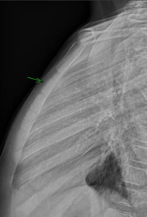 Isolated Sternal Fractures - X-ray of Buckle Fracture