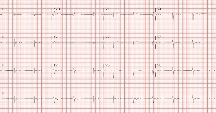 Junctional Escape Rhythm