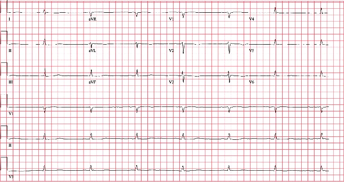 Myxedema coma