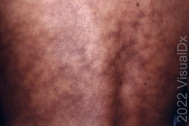 38-Year-Old With Rash After Heating Pad Use