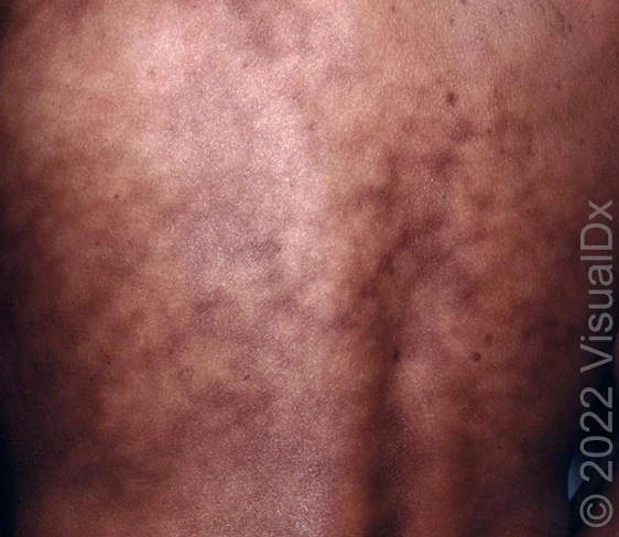 erythema ab igne