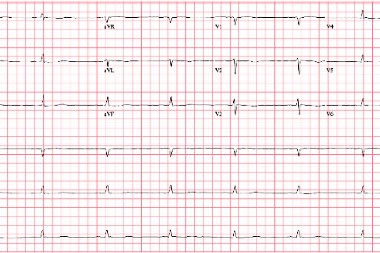 53-Year-Old Female With Fatigue