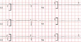 Junctional Escape Rhythm