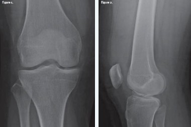 42-Year-Old Soccer Player With Knee Injury