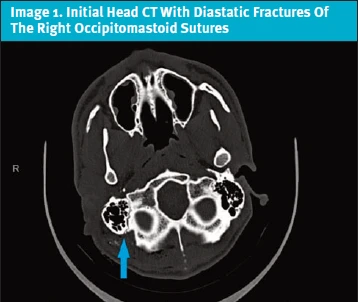 Facial Nerve Palsy Following Gunshot Wound