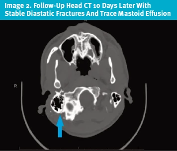 Facial Nerve Palsy Following Gunshot Wound