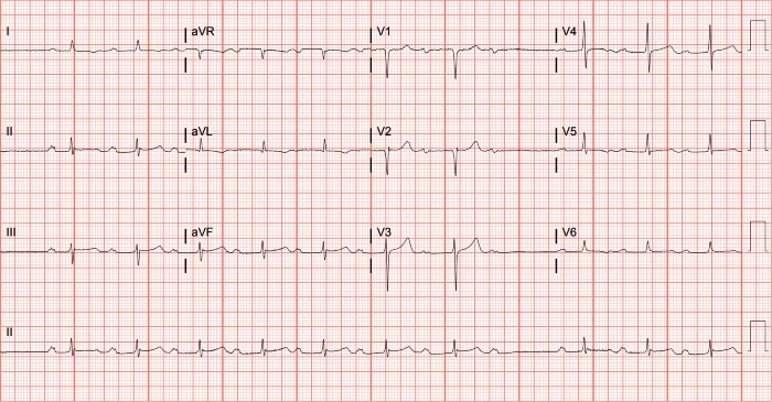 second-degree Mobitz I block ECG