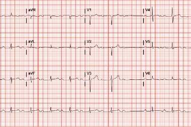 61-Year Old With Light-Headedness