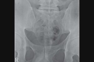 Fused sacroiliac joints