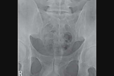 38-Year-Old With Pelvic Pain After a Fall