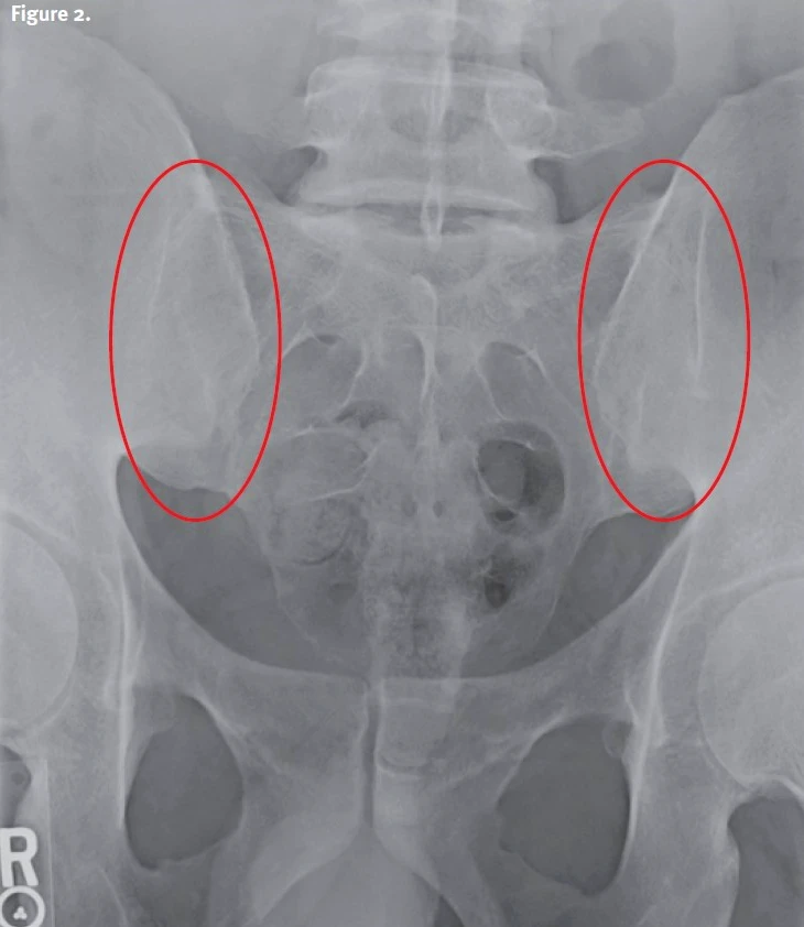 Fused sacroiliac joints