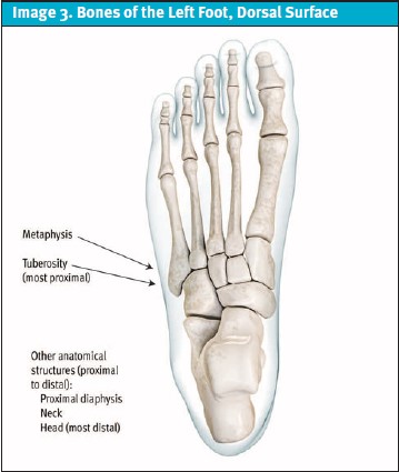Proximal 5th Metatarsal Fractures, Bones of the Left Foot