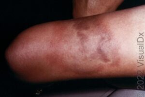 42-Year-Old With Stinging Sensation