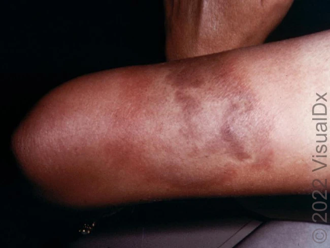 42-Year-Old With Stinging Sensation