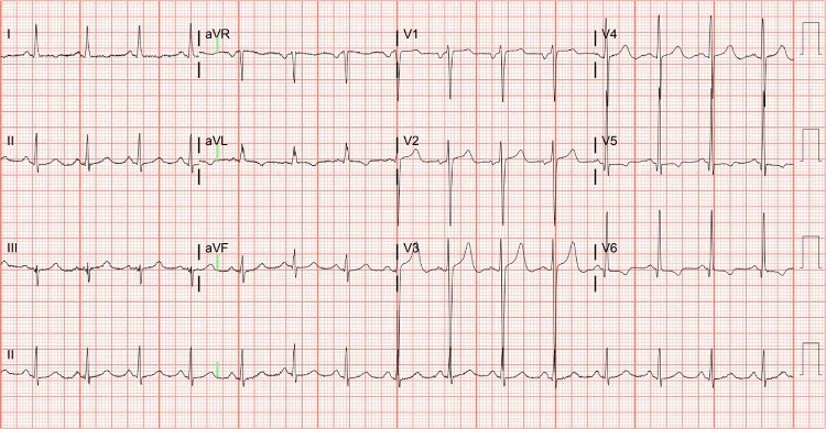 57-Year-Old With Progressive Dyspnea