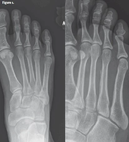 Foot Pain After Hiking X-ray 1