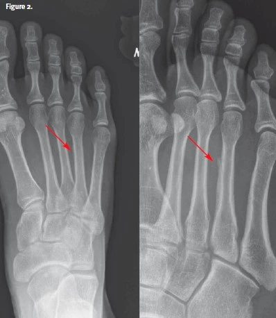 Foot Pain After Hiking