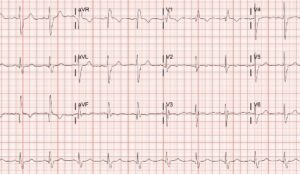 Bifascicular Block ECG