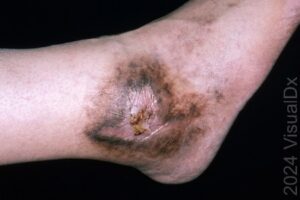 Antiphospholipid antibody syndrome