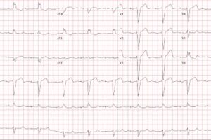 Atrial paced rhythm