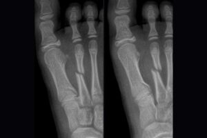 Fractures of the First and Second Metatarsals