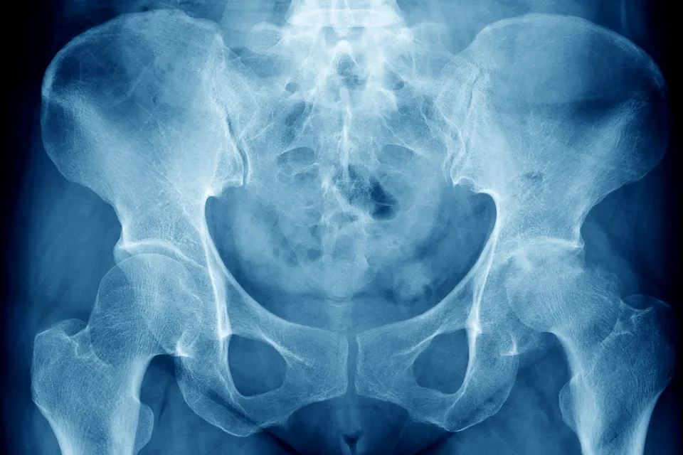Urgent Care Evaluation and Management of Hip Osteoarthritis