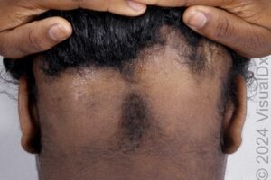 Alopecia Areata