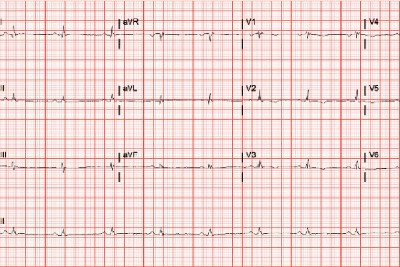 17-Year-Old With Syncope
