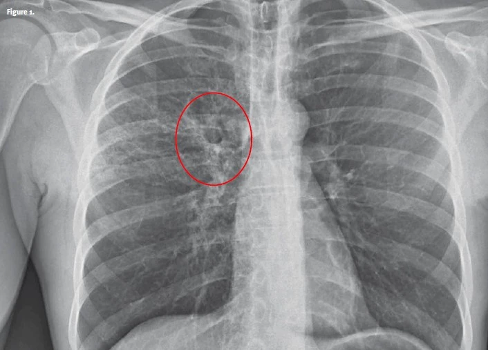 Post-Primary Tuberculosis X-ray resolution circled