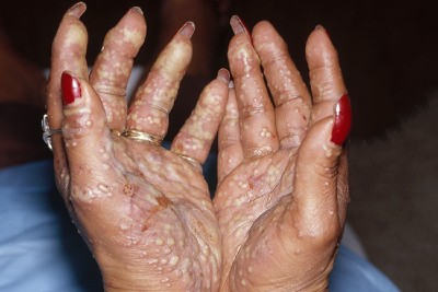 55-Year-Old With Hand Rash