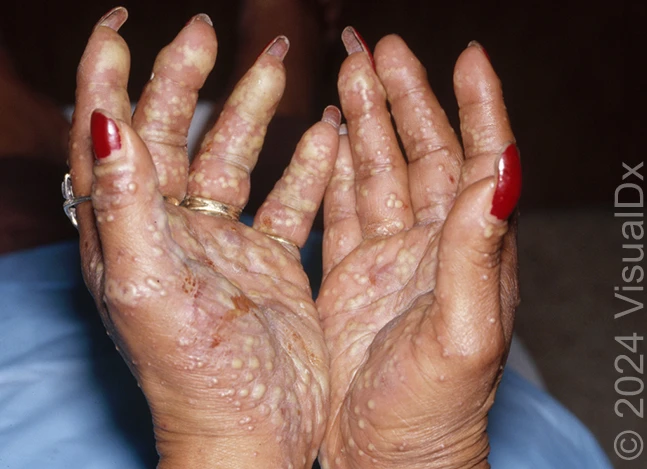 Palmoplantar Pustulosis