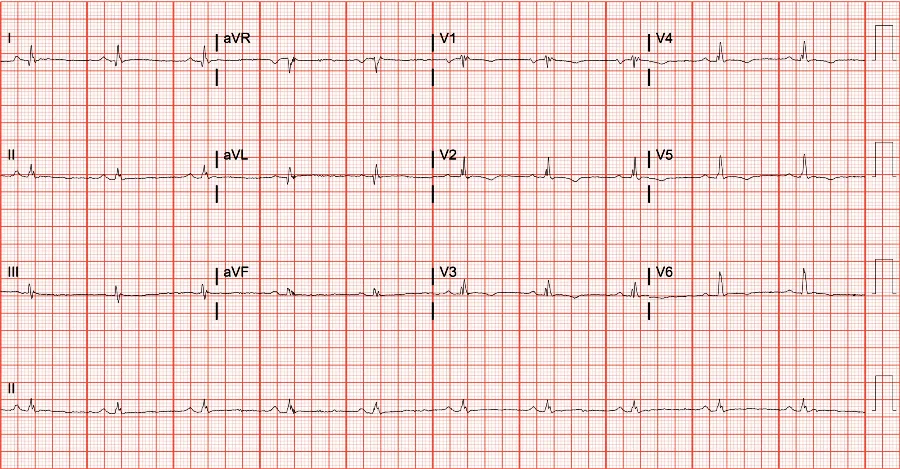 Arrhythmogenic Right Ventricular Cardiomyopathy ECG