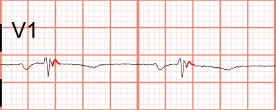 Epsilon waves in V1 identified as the most sensitive finding for ARVC