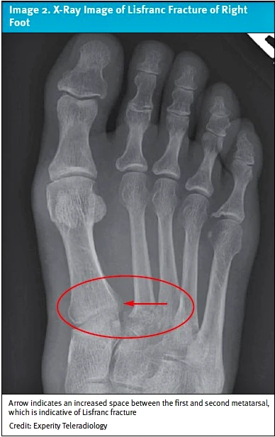 Lisfranc Injuries in Urgent Care x-ray image 4