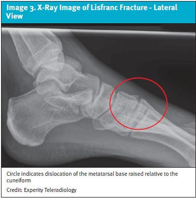 Lisfranc Injuries in Urgent Care X-ray Image 3