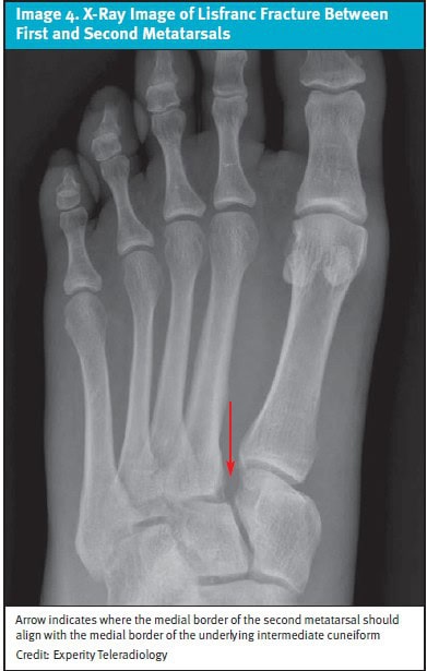 Lisfranc Injuries in Urgent Care