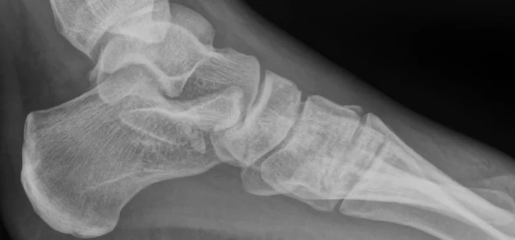 Urgent Care Evaluation and Management of Suspected Lisfranc Injuries