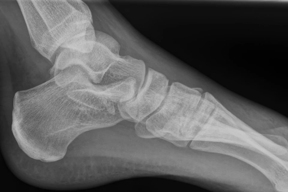 Urgent Care Evaluation and Management of Suspected Lisfranc Injuries