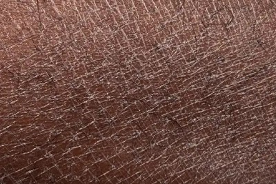55-Year-Old With Diffusely Dry Skin 55-Year-Old With Diffusely Dry Skin