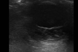 Posterior vitreous detachment