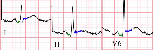 Acute pericarditis ECG Image Blown UP of PQRST Complexes